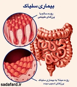 بیماری سلیاک چیست